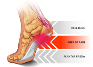 Plantar-Fasciitis-Foot-Anatomy - Central Florida Lifestyle