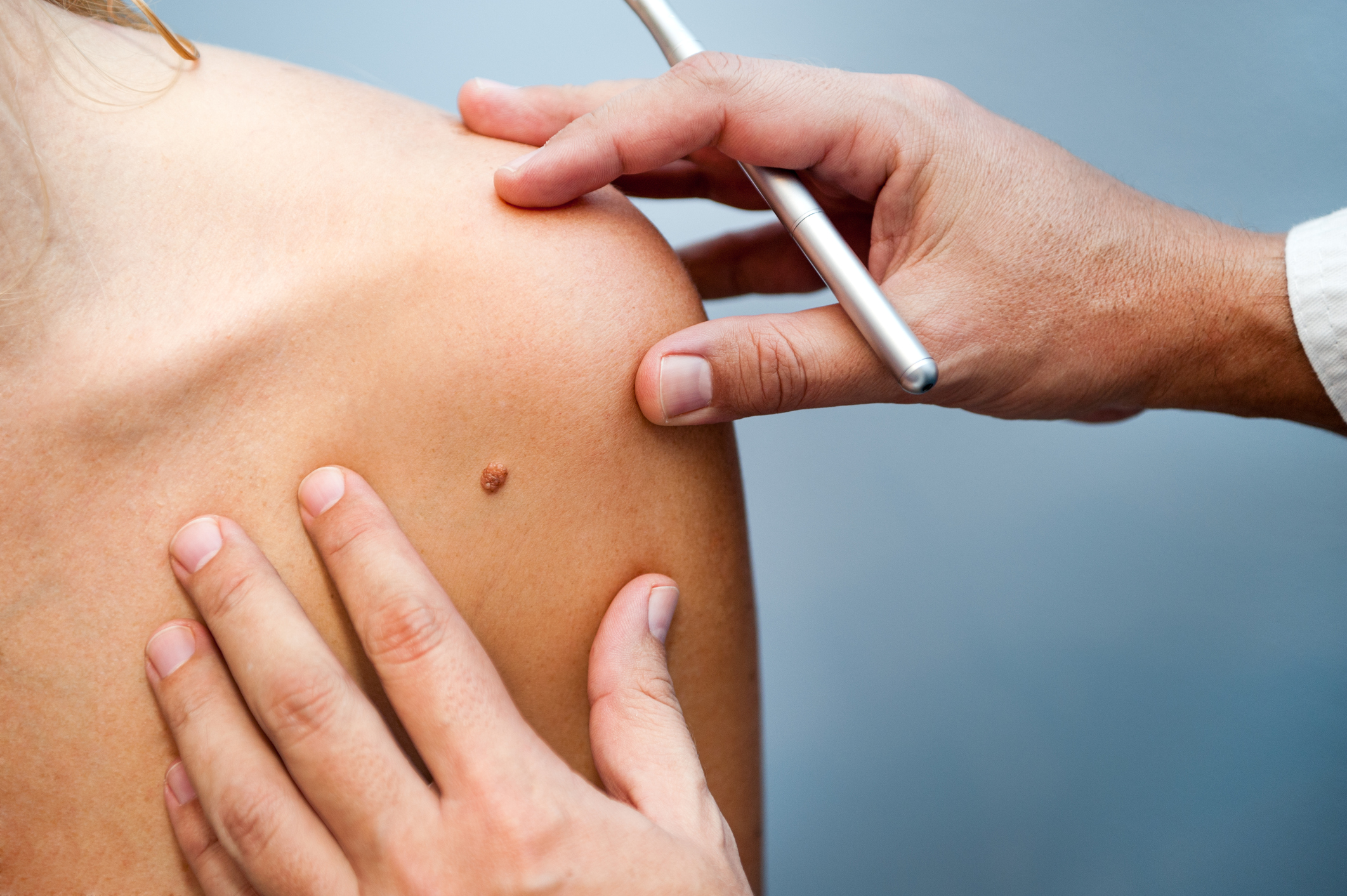 Have You Had a Skin Checkup Lately?