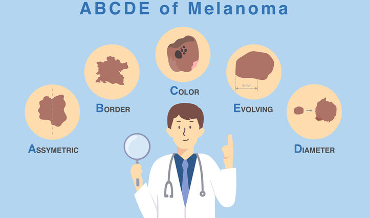 Doctor holding magnifies glass with 5 characteristics of skin damage from cancer cell Illustration about diagnosis and classification of melanoma by use ABCDE letter